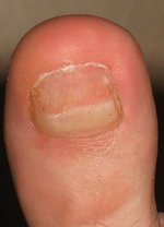 Na nagelreparatie Na nagelreparatie